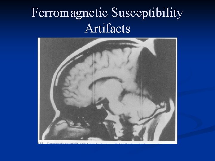 Ferromagnetic Susceptibility Artifacts 