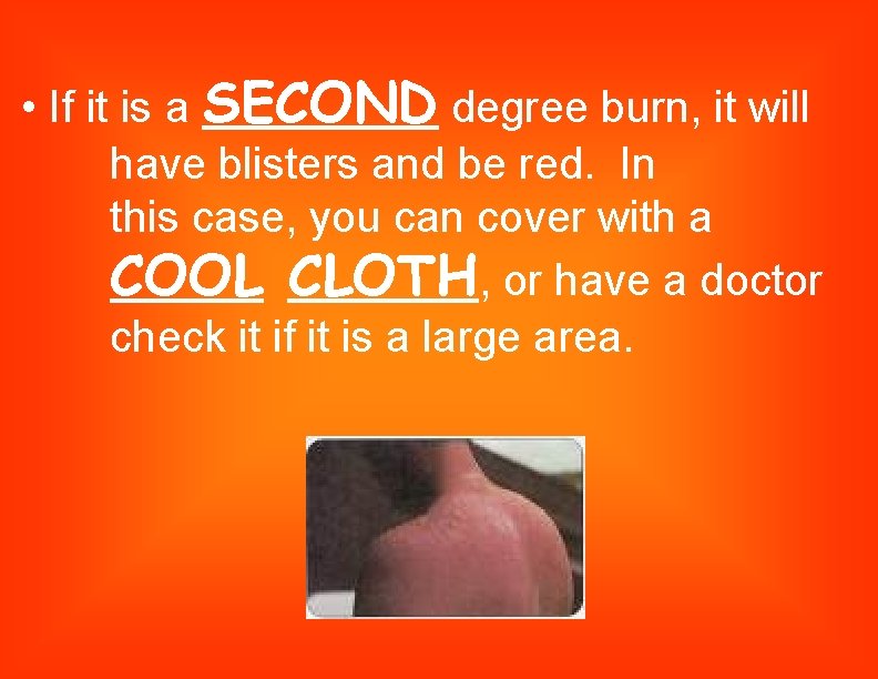  • If it is a SECOND degree burn, it will have blisters and