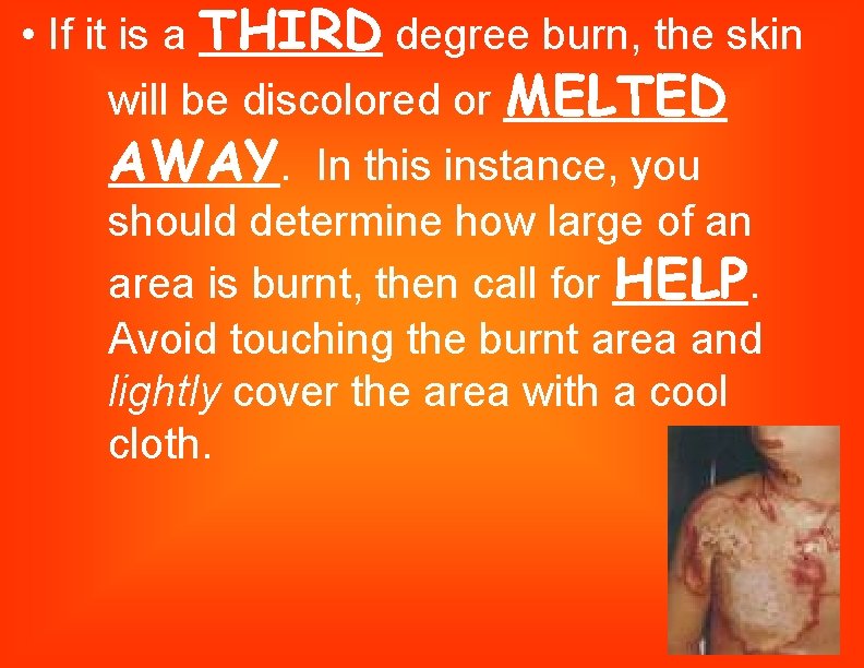  • If it is a THIRD degree burn, the skin will be discolored