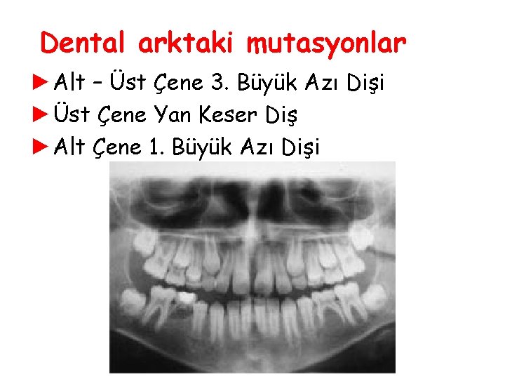 Dental arktaki mutasyonlar ►Alt – Üst Çene 3. Büyük Azı Dişi ►Üst Çene Yan