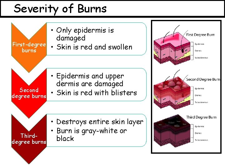 Severity of Burns First-degree burns • Only epidermis is damaged • Skin is red