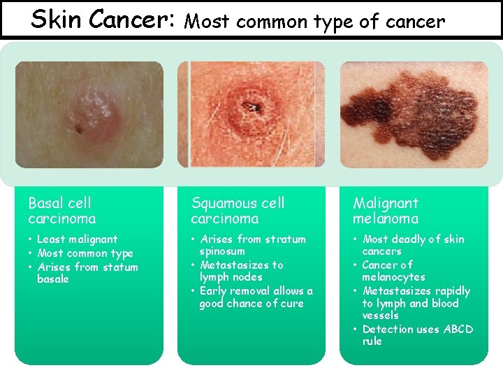 Skin Cancer: Most common type of cancer Basal cell carcinoma Squamous cell carcinoma Malignant