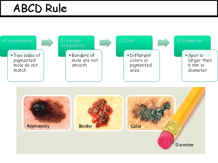 ABCD Rule A: Asymmetry • Two sides of pigmented mole do not match B: