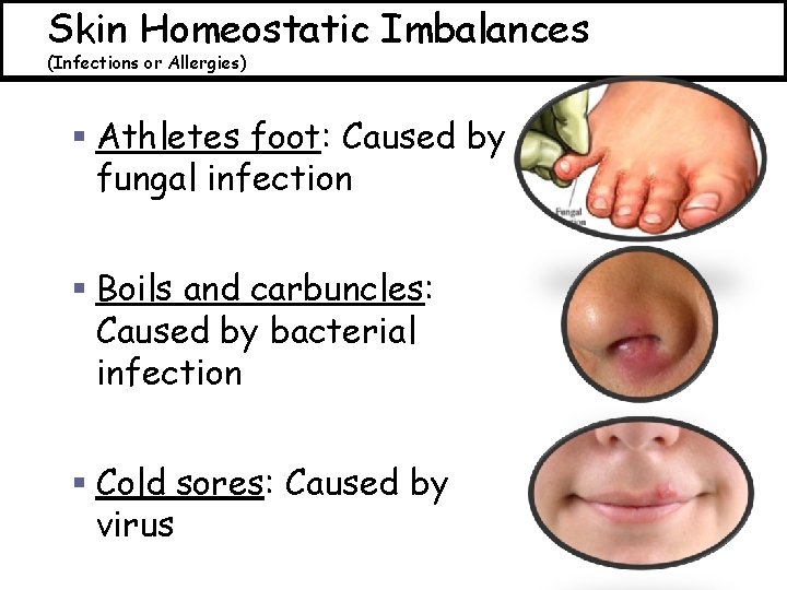 Skin Homeostatic Imbalances (Infections or Allergies) § Athletes foot: Caused by fungal infection §