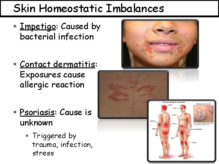 Skin Homeostatic Imbalances § Impetigo: Caused by bacterial infection § Contact dermatitis: Exposures cause