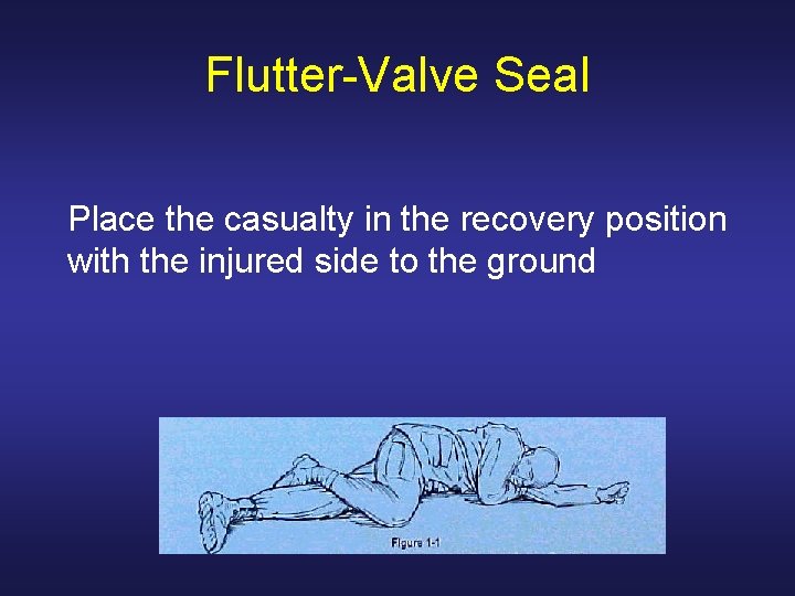 Flutter-Valve Seal Place the casualty in the recovery position with the injured side to