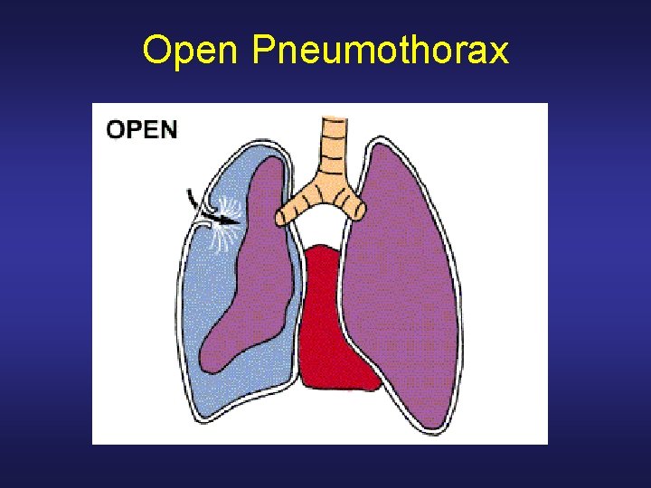 Treating Chest Trauma Introduction The body has