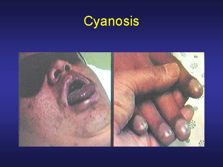 Cyanosis 