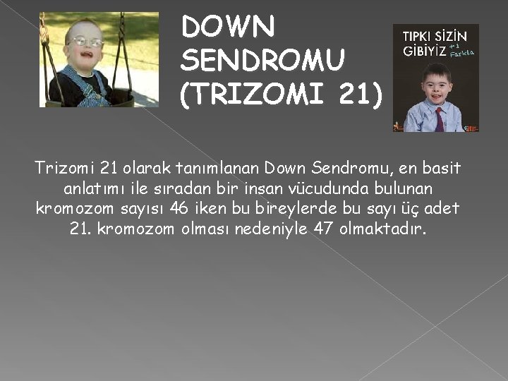 DOWN SENDROMU (TRIZOMI 21) Trizomi 21 olarak tanımlanan Down Sendromu, en basit anlatımı ile