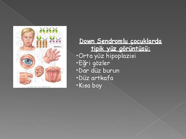 Down Sendromlu çocuklarda tipik yüz görüntüsü: • Orta yüz hipoplazisi • Eğri gözler •