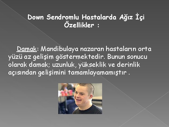 Down Sendromlu Hastalarda Ağız İçi Özellikler : Damak: Mandibulaya nazaran hastaların orta yüzü az