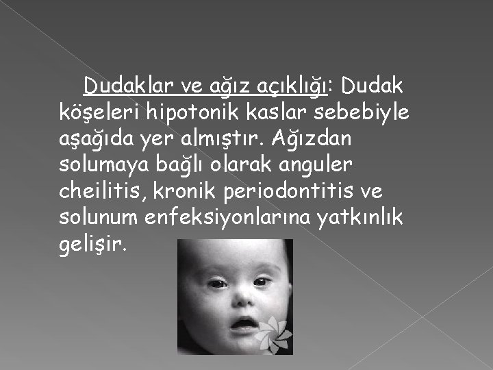 Dudaklar ve ağız açıklığı: Dudak köşeleri hipotonik kaslar sebebiyle aşağıda yer almıştır. Ağızdan solumaya