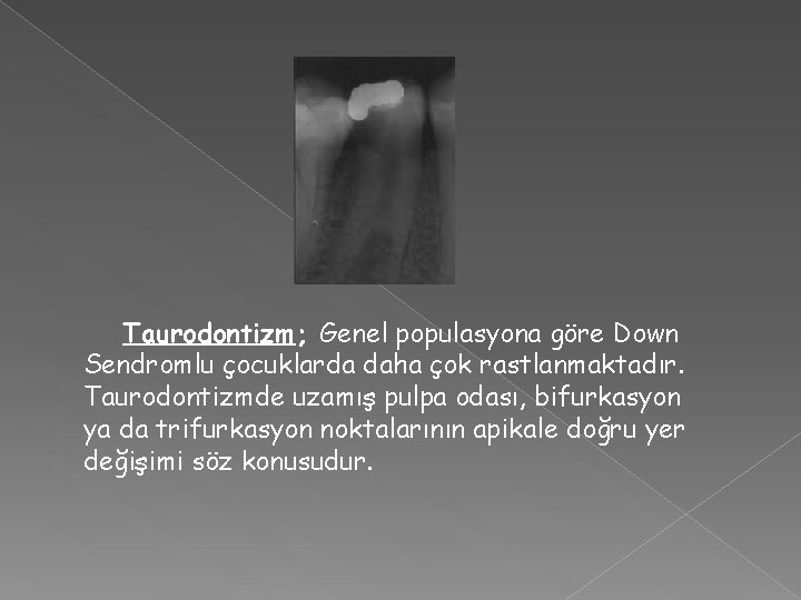 Taurodontizm; Genel populasyona göre Down Sendromlu çocuklarda daha çok rastlanmaktadır. Taurodontizmde uzamış pulpa odası,