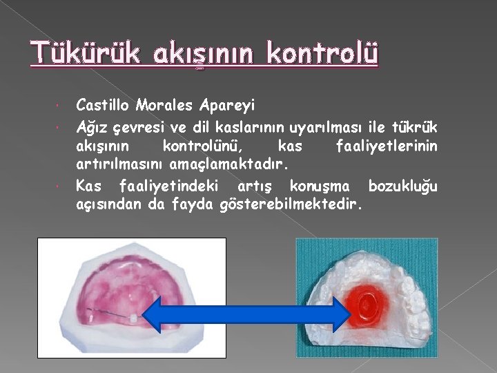 Tükürük akışının kontrolü Castillo Morales Apareyi Ağız çevresi ve dil kaslarının uyarılması ile tükrük