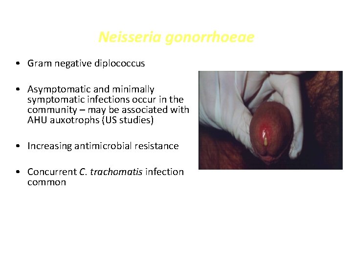 Neisseria gonorrhoeae • Gram negative diplococcus • Asymptomatic and minimally symptomatic infections occur in