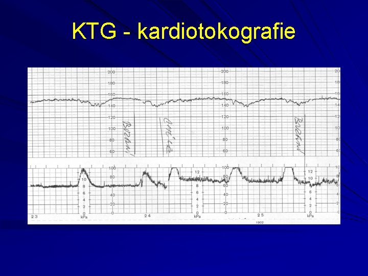 KTG - kardiotokografie 