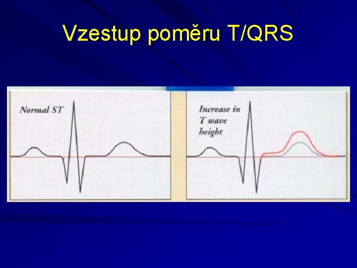 Vzestup poměru T/QRS 