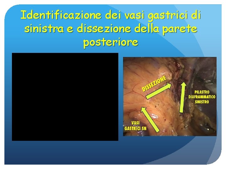 Identificazione dei vasi gastrici di sinistra e dissezione della parete posteriore 