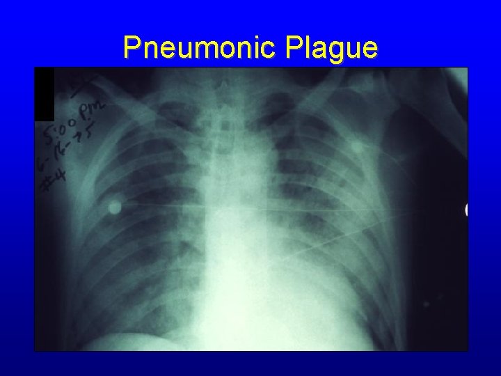 Pneumonic Plague 