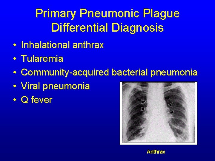 Primary Pneumonic Plague Differential Diagnosis • • • Inhalational anthrax Tularemia Community-acquired bacterial pneumonia