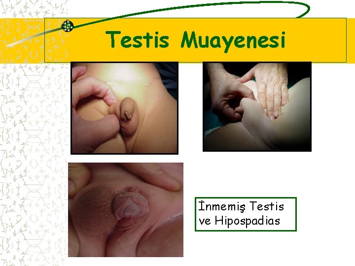 Testis Muayenesi İnmemiş Testis ve Hipospadias 