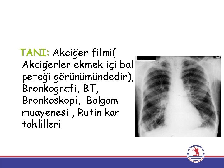 TANI: Akciğer filmi( Akciğerler ekmek içi bal peteği görünümündedir), Bronkografi, BT, Bronkoskopi, Balgam muayenesi