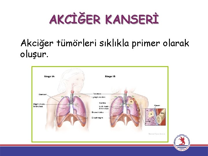 AKCİĞER KANSERİ Akciğer tümörleri sıklıkla primer olarak oluşur. 