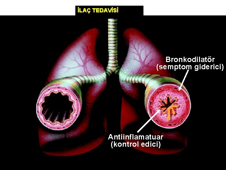 İLAÇ TEDAVİSİ Bronkodilatör (semptom giderici) Antiinflamatuar (kontrol edici) 