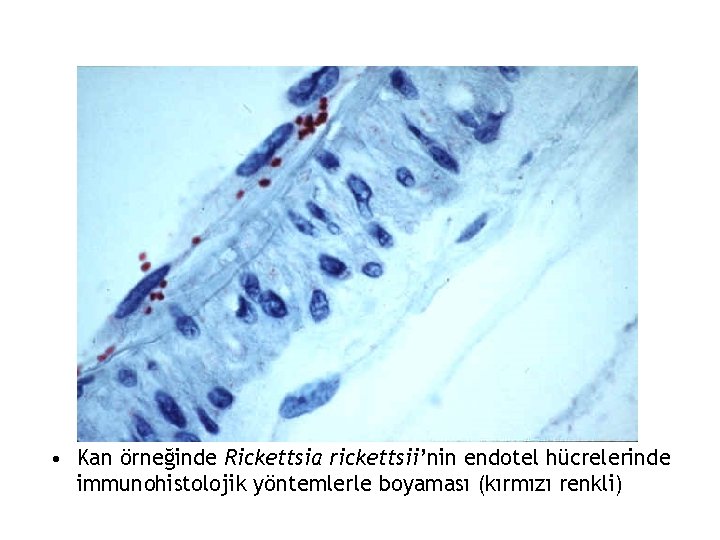  • Kan örneğinde Rickettsia rickettsii’nin endotel hücrelerinde immunohistolojik yöntemlerle boyaması (kırmızı renkli) 