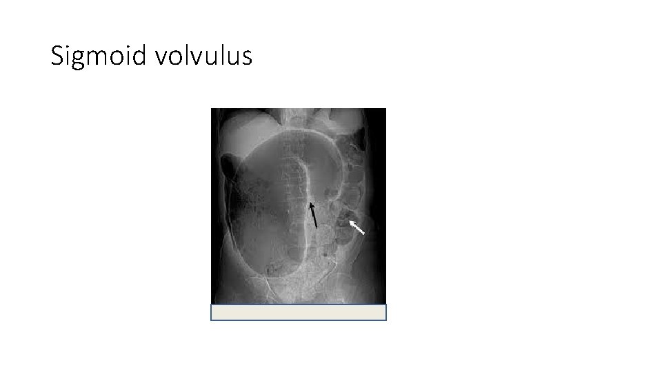 Sigmoid volvulus 