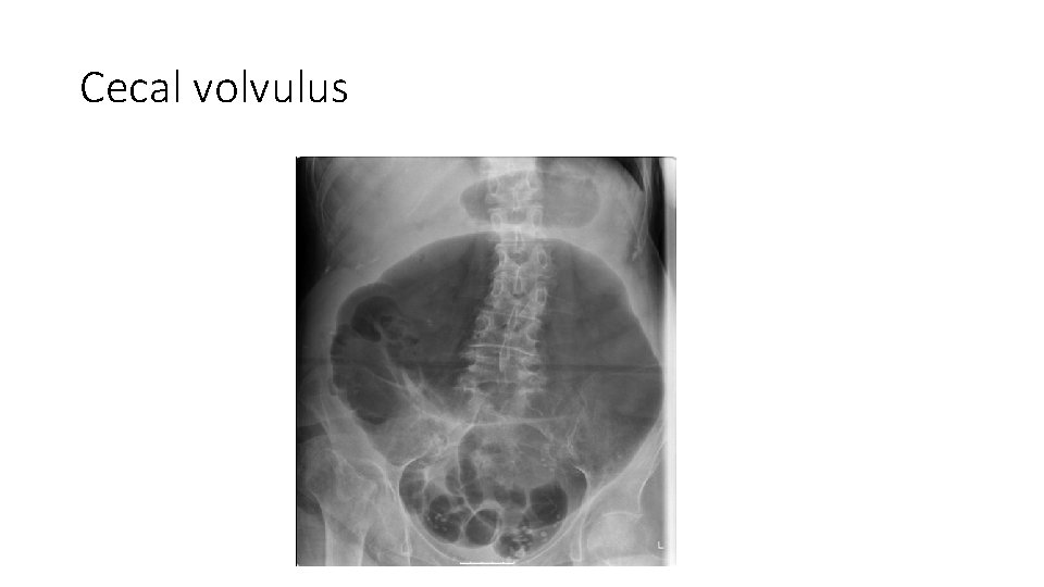 Cecal volvulus 