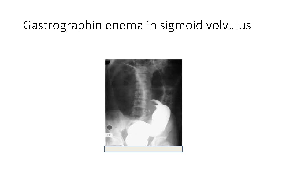 Gastrographin enema in sigmoid volvulus 