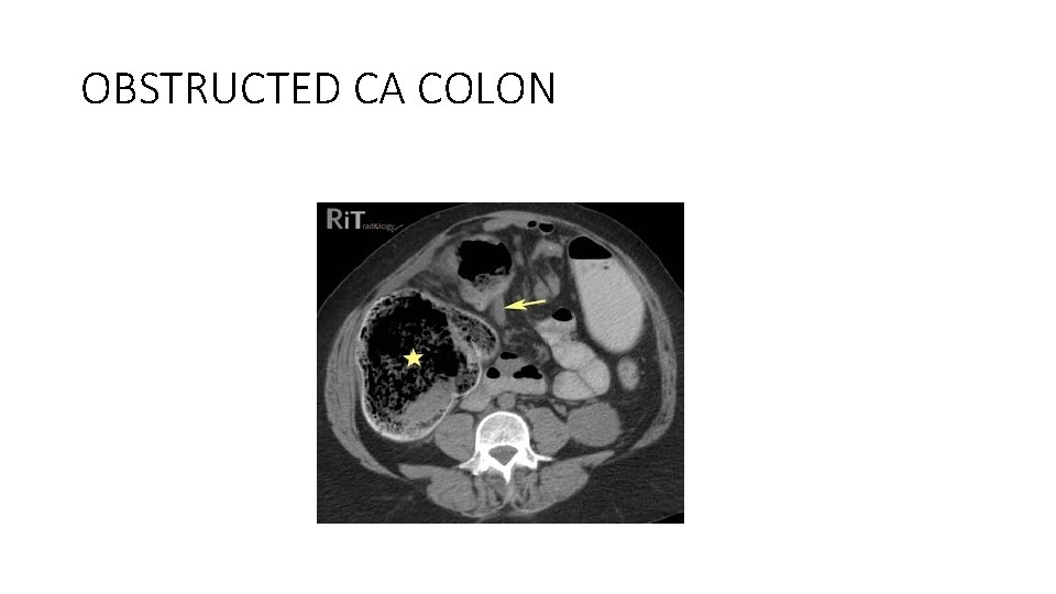 OBSTRUCTED CA COLON 