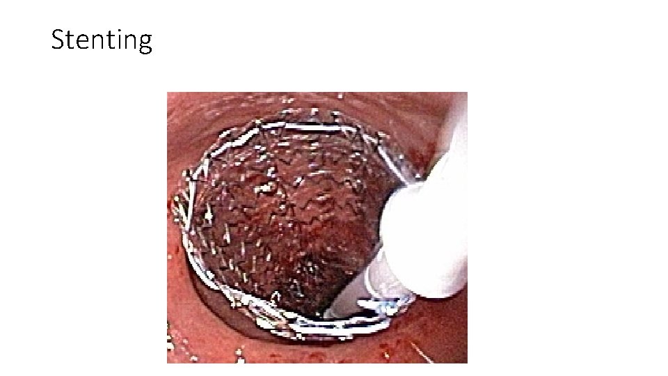 Stenting 