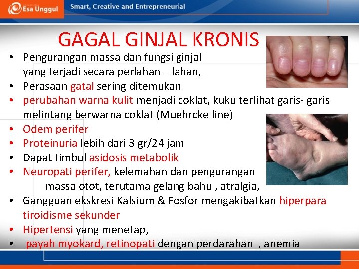 GAGAL GINJAL KRONIS • Pengurangan massa dan fungsi ginjal yang terjadi secara perlahan –