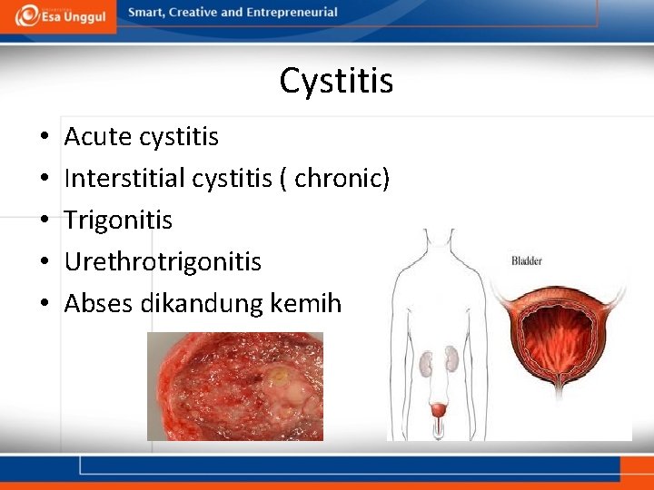 Cystitis • • • Acute cystitis Interstitial cystitis ( chronic) Trigonitis Urethrotrigonitis Abses dikandung