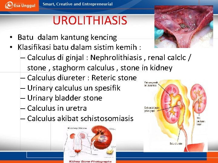 UROLITHIASIS • Batu dalam kantung kencing • Klasifikasi batu dalam sistim kemih : –