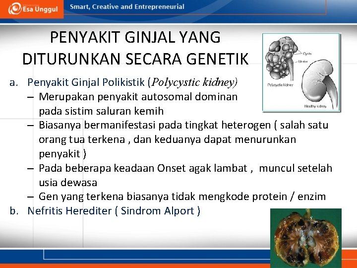 PENYAKIT GINJAL YANG DITURUNKAN SECARA GENETIK a. Penyakit Ginjal Polikistik (Polycystic kidney) – Merupakan