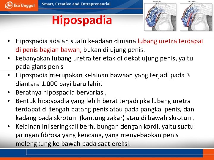 Hipospadia • Hipospadia adalah suatu keadaan dimana lubang uretra terdapat di penis bagian bawah,