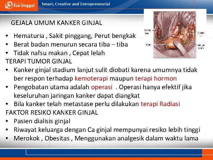 GEJALA UMUM KANKER GINJAL • Hematuria , Sakit pinggang, Perut bengkak • Berat badan