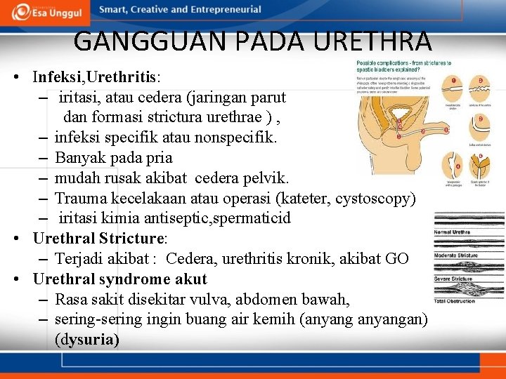 GANGGUAN PADA URETHRA • Infeksi, Urethritis: – iritasi, atau cedera (jaringan parut dan formasi