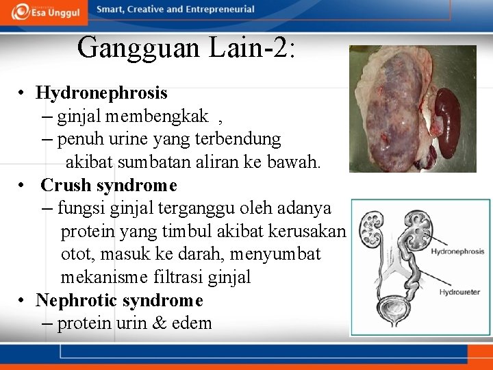 Gangguan Lain-2: • Hydronephrosis – ginjal membengkak , – penuh urine yang terbendung akibat