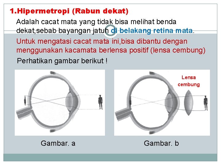 1. Hipermetropi (Rabun dekat) Adalah cacat mata yang tidak bisa melihat benda dekat, sebab