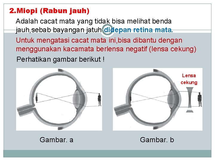 2. Miopi (Rabun jauh) Adalah cacat mata yang tidak bisa melihat benda jauh, sebab