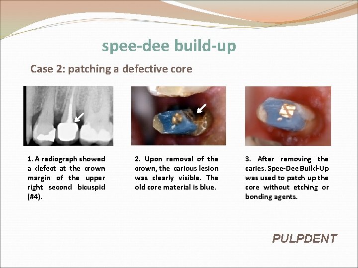 spee-dee build-up Case 2: patching a defective core 1. A radiograph showed a defect spee-dee build-up Case 2: patching a defective core 1. A radiograph showed a defect