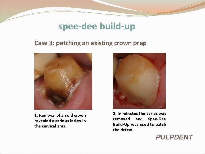 spee-dee build-up Case 3: patching an existing crown prep 1. Removal of an old spee-dee build-up Case 3: patching an existing crown prep 1. Removal of an old