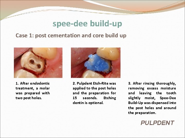 spee-dee build-up Case 1: post cementation and core build up 1. After endodontic treatment, spee-dee build-up Case 1: post cementation and core build up 1. After endodontic treatment,