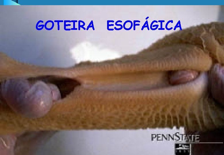 GOTEIRA ESOFÁGICA 