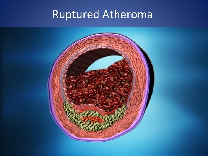 Ruptured Atheroma 