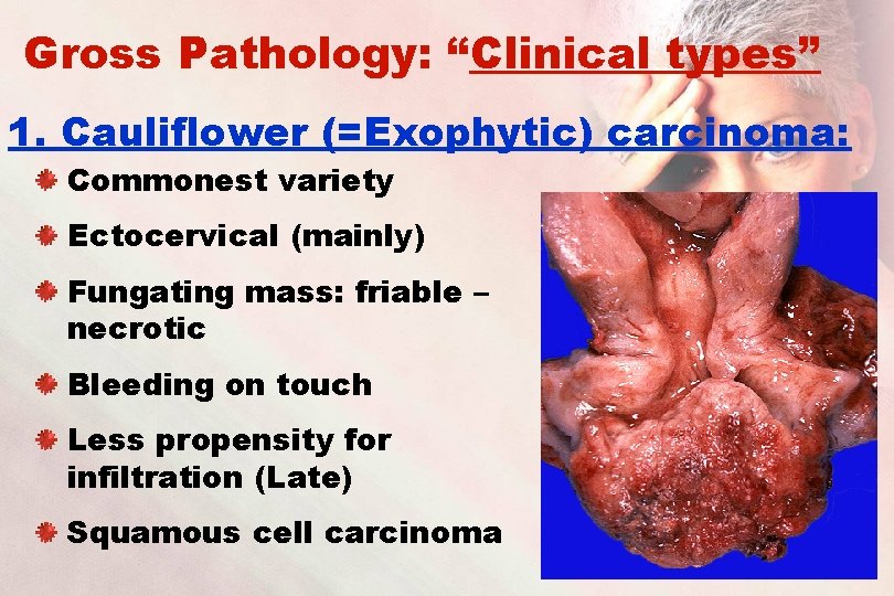Gross Pathology: “Clinical types” 1. Cauliflower (=Exophytic) carcinoma: Commonest variety Ectocervical (mainly) Fungating mass:
